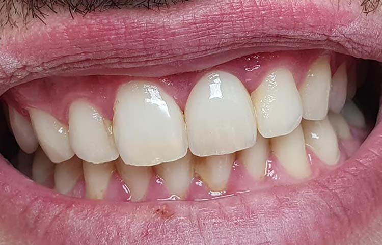 Zubný implantát